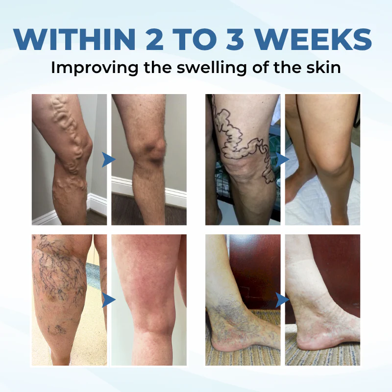 NovaRX® TheraVein Varicose Herbal Spray