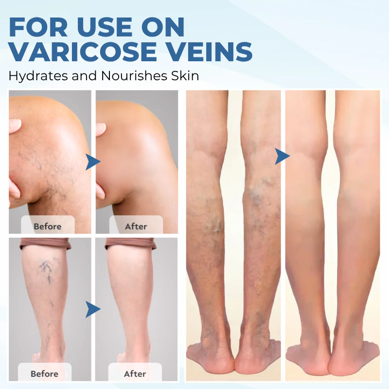 NovaRX® TheraVein Varicose Herbal Spray