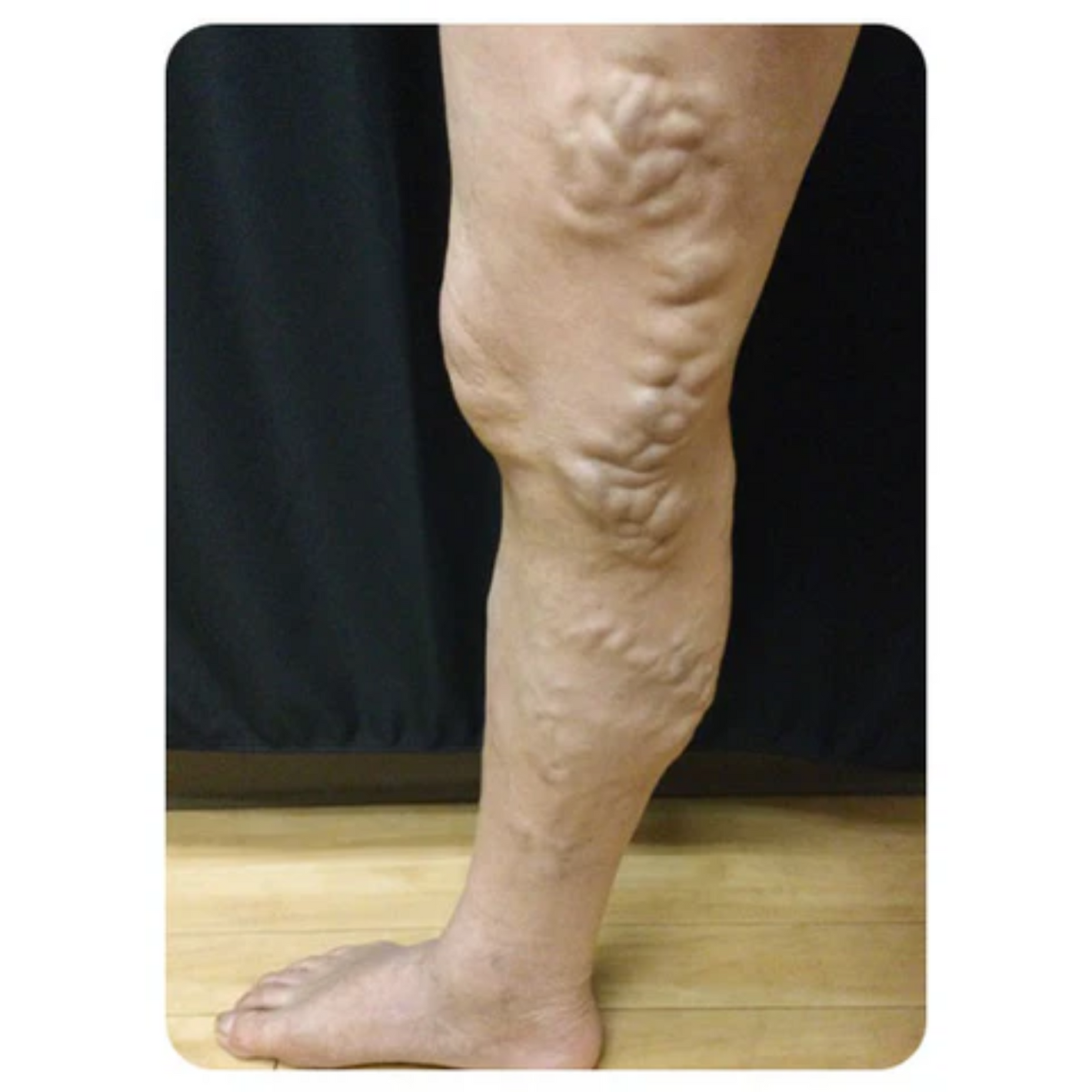 NovaRX® VeinTarget Nanotech Microneedle Patch 30 NovaRX® VeinTarget Nanotech Microneedle Patch