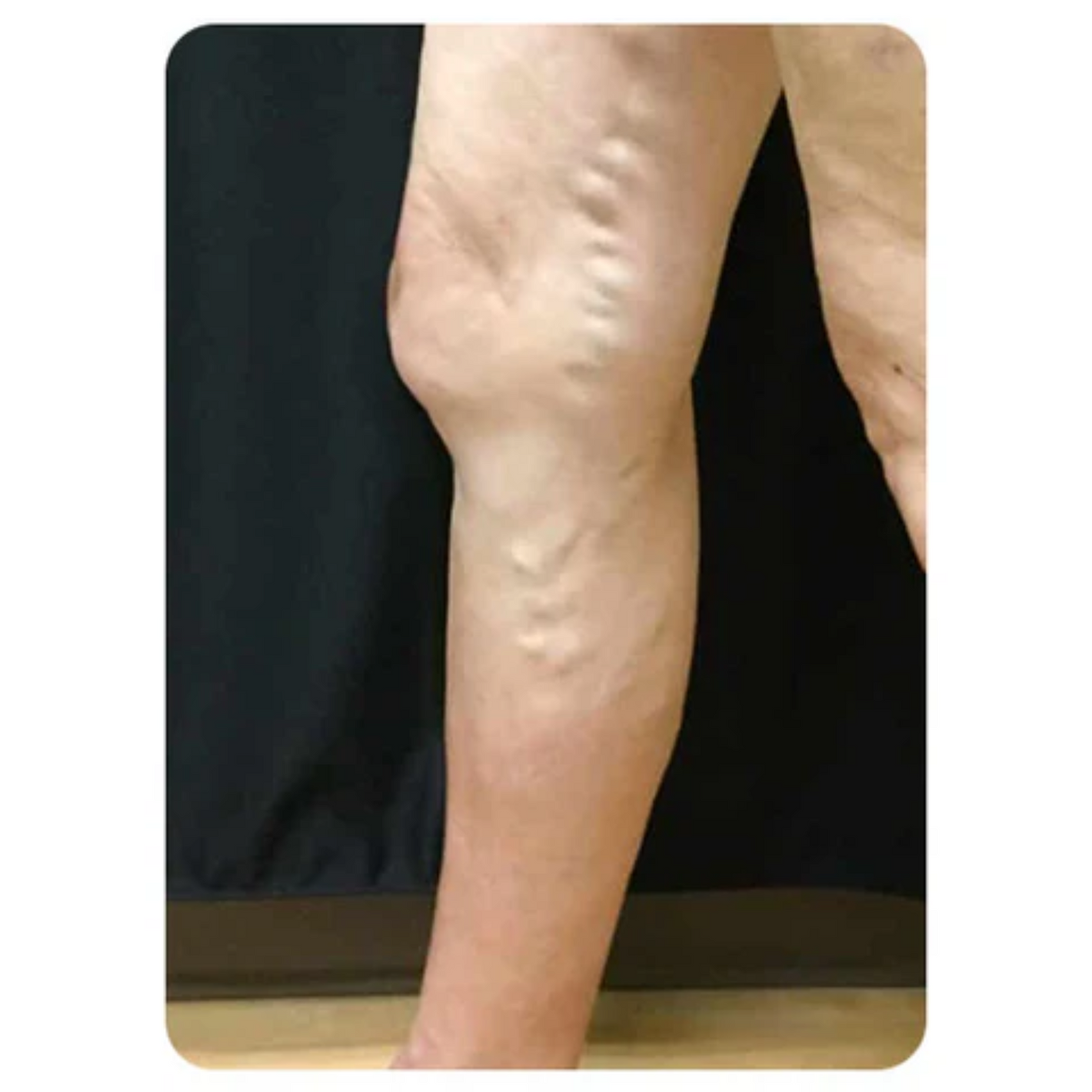 NovaRX® VeinTarget Nanotech Microneedle Patch 31 NovaRX® VeinTarget Nanotech Microneedle Patch