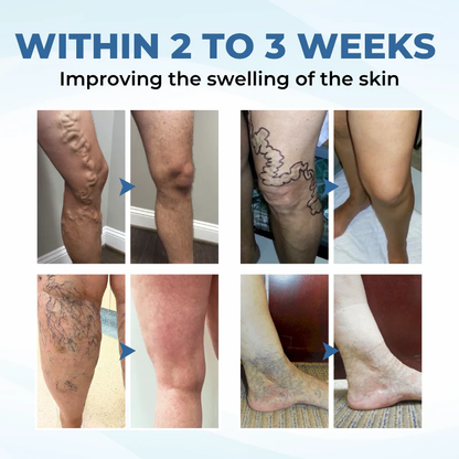 NovaRX® TheraVein Varicose Herbal Spray