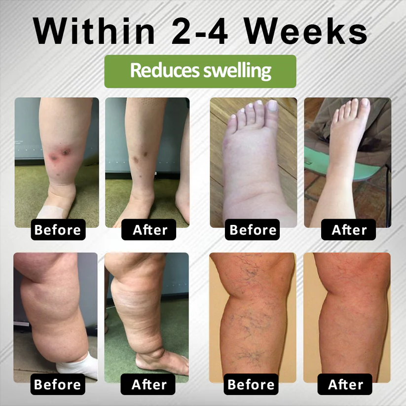 NovaRX® Edema Drain Duo Therapy Roller Cream