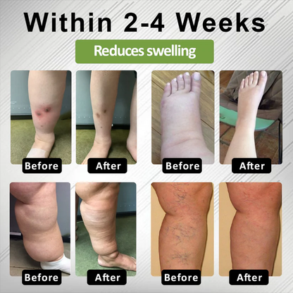 NovaRX® Edema Drain Duo Therapy Roller Cream